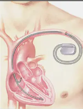 細(xì)數(shù)心臟起搏器和ICD之間的差異 細(xì)數(shù)心臟起搏器和ICD之間的差異